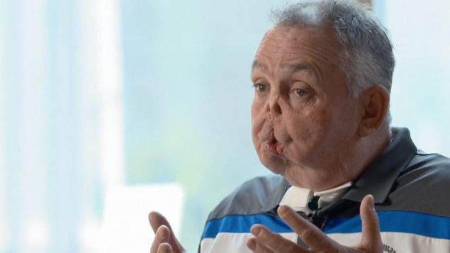 موريس ديجاردان، المريض الذي أُجريت له أوّل عملية زراعة وجه في كندا، قبل إجرائها - Radio Canada