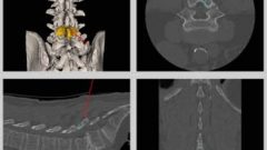 Example of the real time moving images created by the new scanner. Surgeons can immediately see on a screen the exact position of their instruments and any tumours, or placement of screws or support rods (courtesy Dr V Yang) CLICK to enlarge