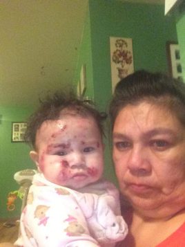 "This is the face of the medical crisis hitting Treaty 9," he said in a Twitter post on Friday, after former Kashechewan chief Derek Stephen posted unsettling pictures of his infant niece covered in lesions.