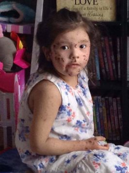 Some children in Kashechewan First Nation have developed rashes and even painful sores on their bodies. Tasheena Wesley