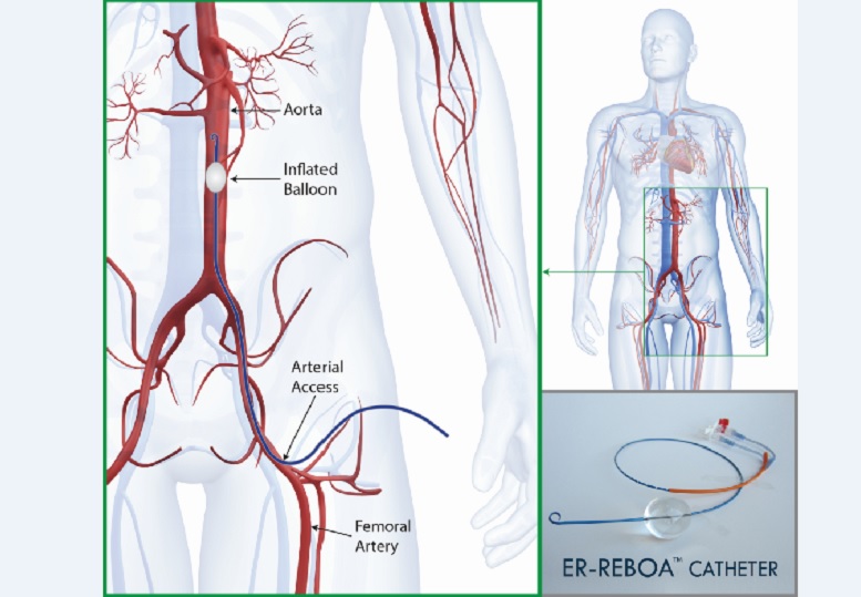 Diagram showing how the device is inserted and used (via MUHC)