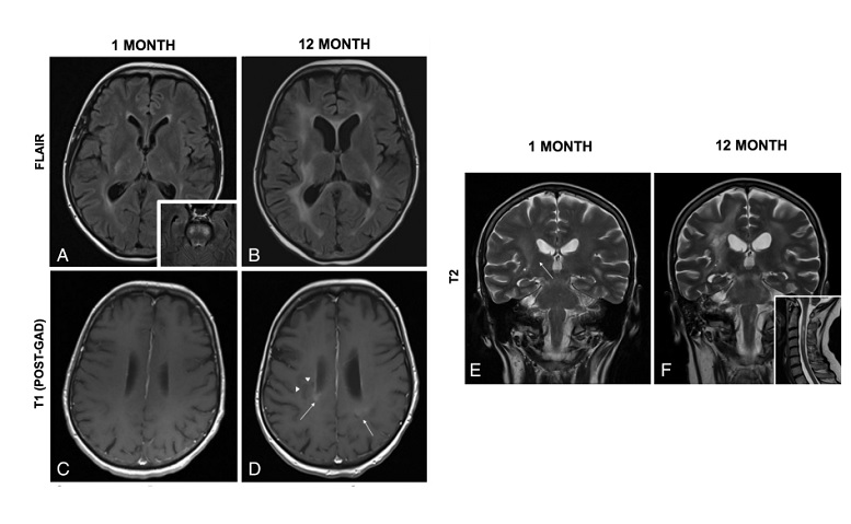 FIGURE 1: Progressive white matter disease in HPgV-1 infection. Fluid-attenuated inversion recovery (FLAIR) magnetic resonance (MR) images revealed multifocal lesions in the periventricular white matter at initial presentation (A) with progression at 12 months (B) in LE-1. Increased white matter signal was present in the brainstem at initial presentation (A; inset). Gadolinium T1-weighted MR images exhibited enhancing lesions in the posterior periventricular white matter at 12 months (D; indicated by arrows) that were not present at initial presentation (C), as well as a lesion in the right posterior periventricular region that was suggestive of infarction (indicated by triangles). T2-weighted MR images showed lesions throughout the corona radiata bilaterally (E) that progressed over 12 months (F) with marked involvement of the brainstem and cervical spinal cord (F; inset). HPgV-1 = human pegivirus-1 (BALCOM et al)