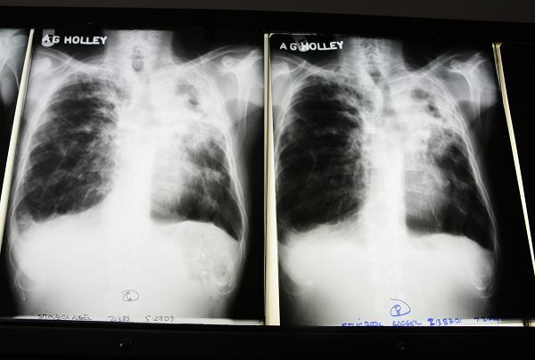 X-rays from a tuberculosis patient. Photo: Lynne Sladky, AP Photo. 