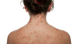 A woman with atopic dermatitits, a type of eczema, is shown. (iStock)