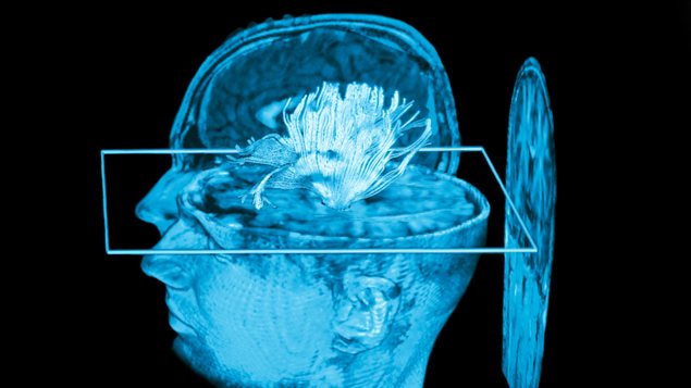 Selon des chercheurs allemands, américains et canadiens, des changements dans l’architecture du cerveau se produisent chez les enfants victimes de sévices sexuels ou émotionnels. D’après le professeur Jens Pruessner de l’Université McGill à Montréal on peut même mesurer l’importance de la blessure psychologique causée par une agression. Photo Credit: iStockphoto