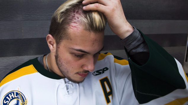 Un des survivants de l'accident des Broncos de Humboldt montre les cicatrices toujours viisble sur son crâne un mois après la tragédie.