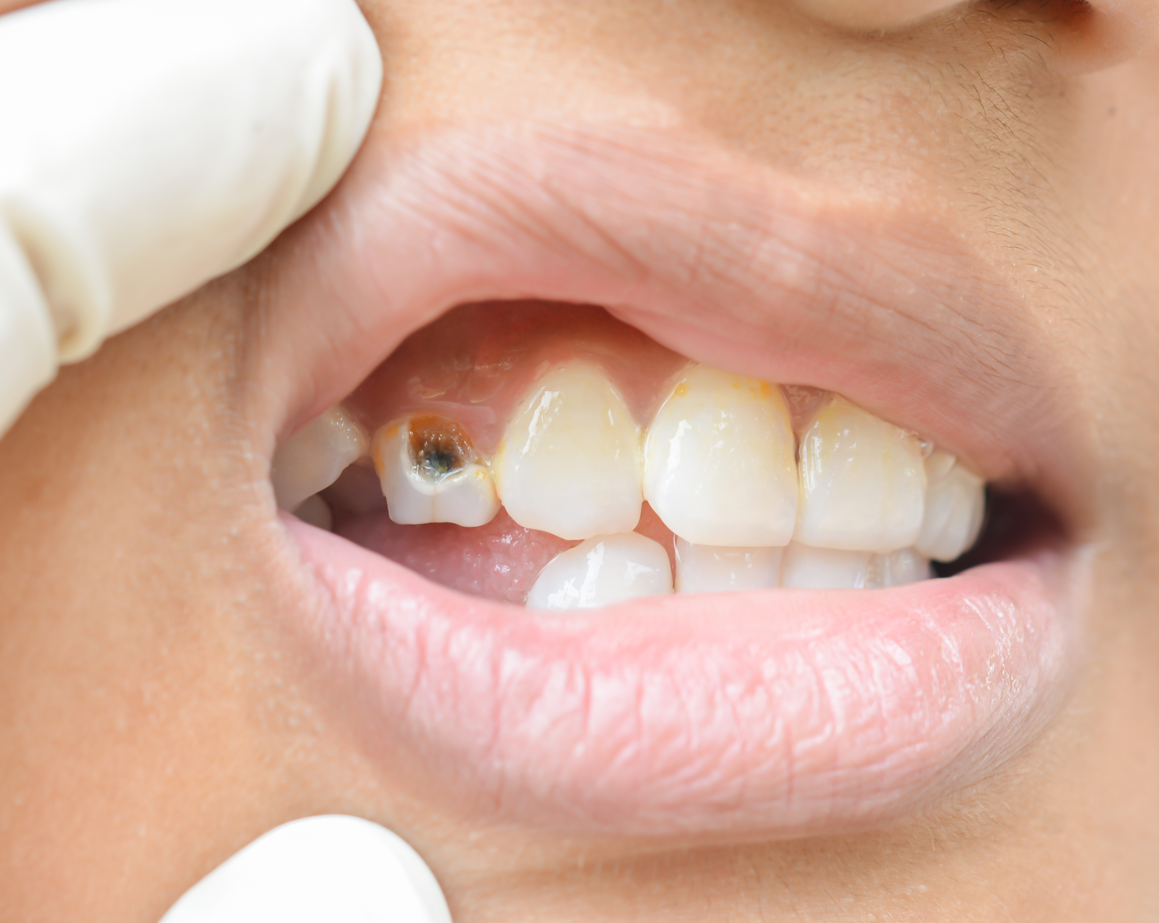 Un dentifrice qui élimine plus de la moitié des caries? Oui, et c’est