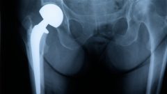 Une radiograophie qui montre une prothèse de la hanche.