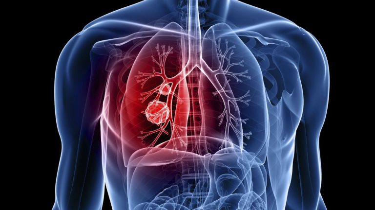 Statistiche: i processi di cancro aumentano con l’aumento del reddito dei pazienti – RCI