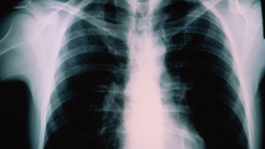 There are now 15 active cases of TB in Salluit, four in Umiujaq and another two in Kuujjuaq. (Getty Images)