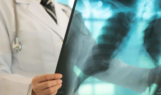 Une personne en blouse blanche tient une radiographie de poumons.