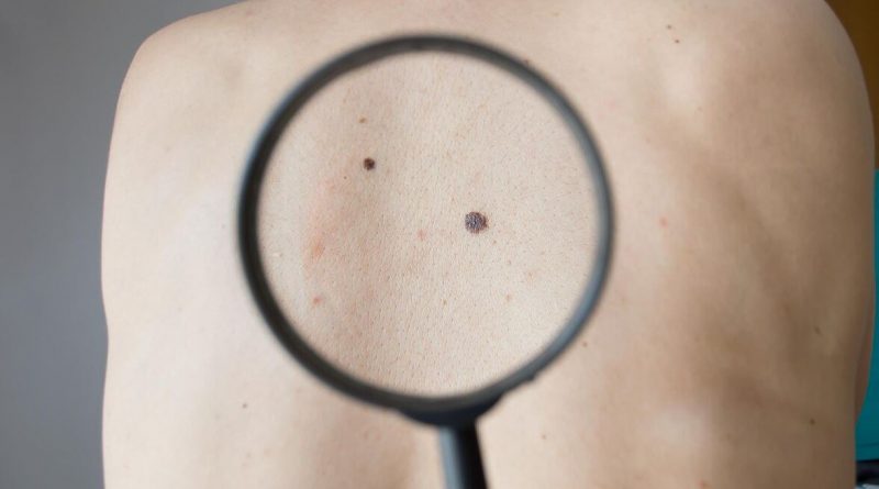 Une loupe cible des grains de beauté dans le dos d'une personne.