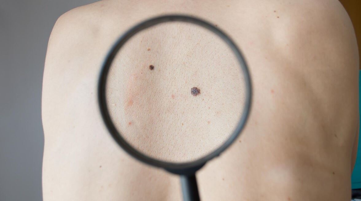 Une loupe cible des grains de beauté dans le dos d'une personne.