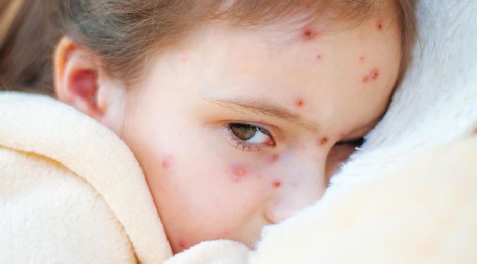 La fillette a des boutons sur le visage et est couchée dans son lit.